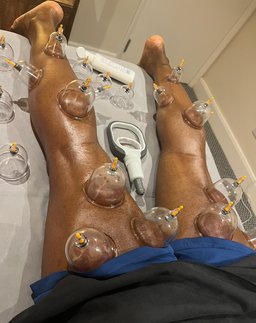 Recovery Cupping Therapy service